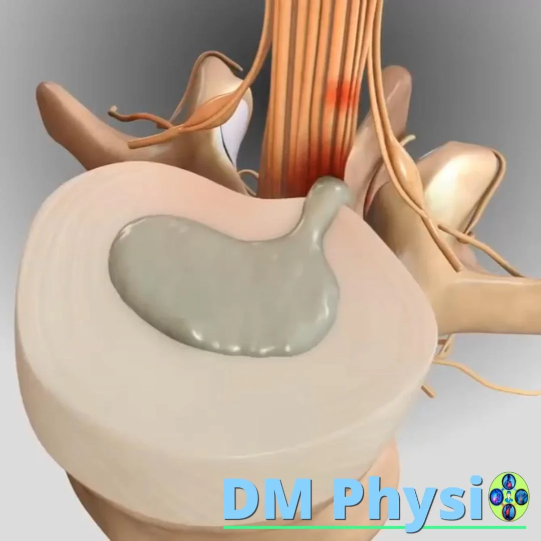 Дискова херния на гърба - визуализация